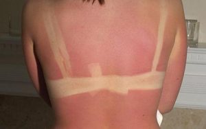 Kirsty McRae, 14, who was admitted to hospital in Cardiff with third degree burns after using a sun bed for 19 minutes at a salon in Barry, South Wales.  WALES NEWS SERVICE